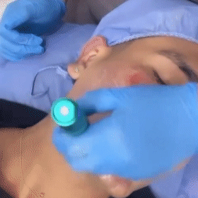 Dermapen Margiestetic