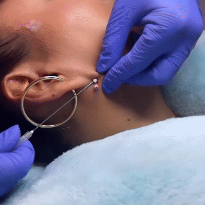 Hilos tensores Margiestetic